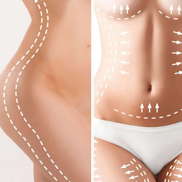 LIPOESCULTURA EN GUAYAQUIL