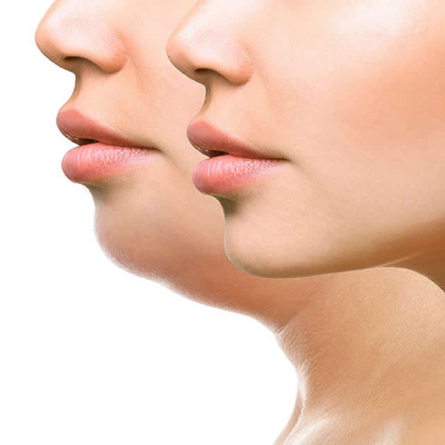 LIPOSUCCION DE PAPADA EN GUAYAQUIL