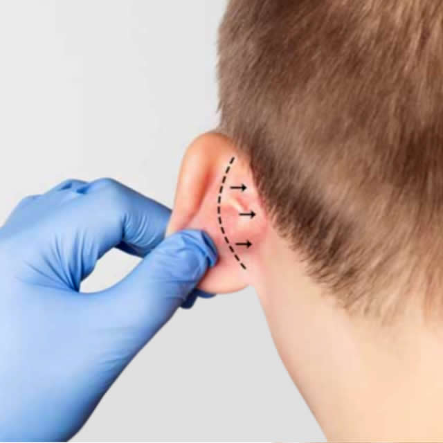 OTOPLASTIA EN GUAYAQUIL